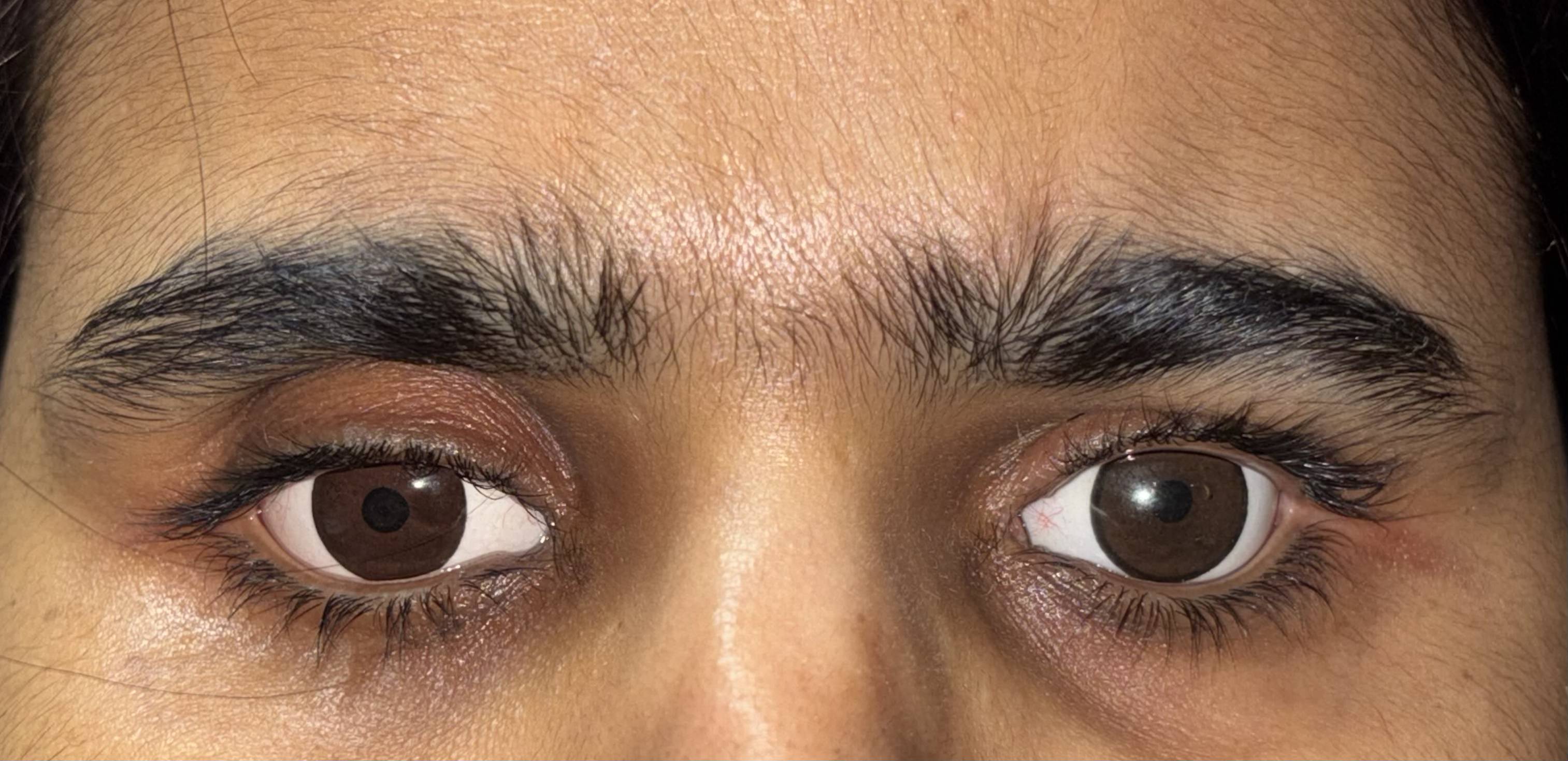 Natural artificial eye prosthesis rehabilitation showing premium cosmetic matching by Dr. Saumika Singh