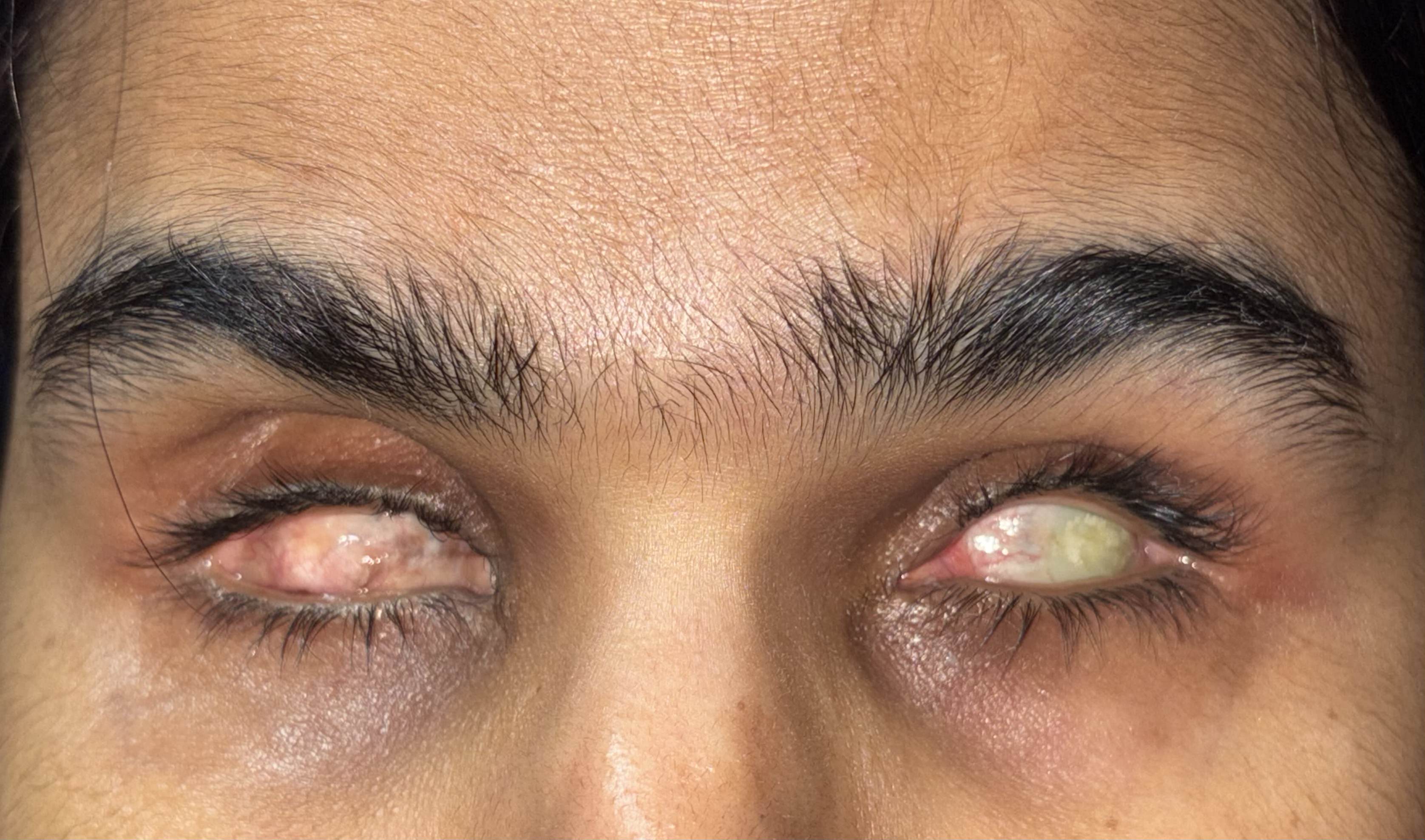 Anophthalmic socket volume loss before custom prosthesis fitting by Dr. Saumika Singh