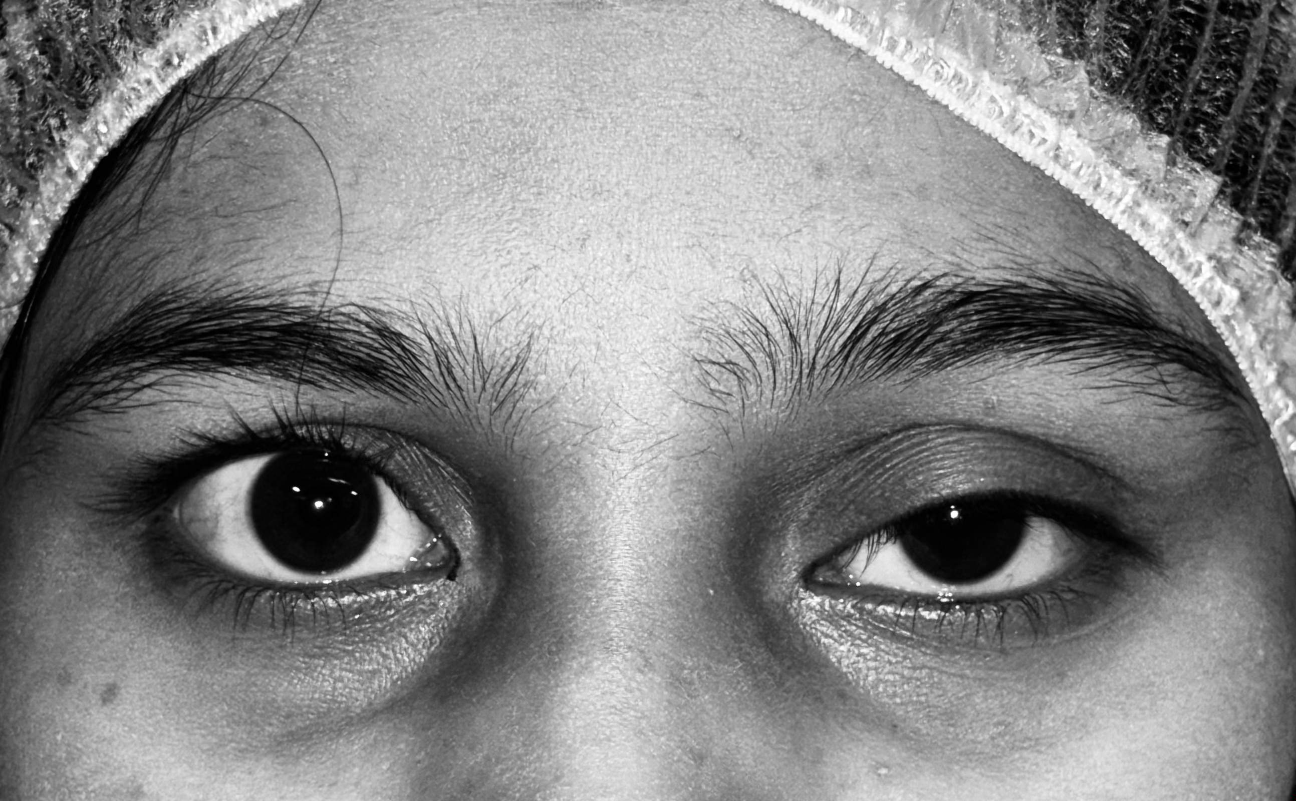 Severe Ptosis (Drooping Upper Eyelid) before surgical correction by Dr. Saumika Singh