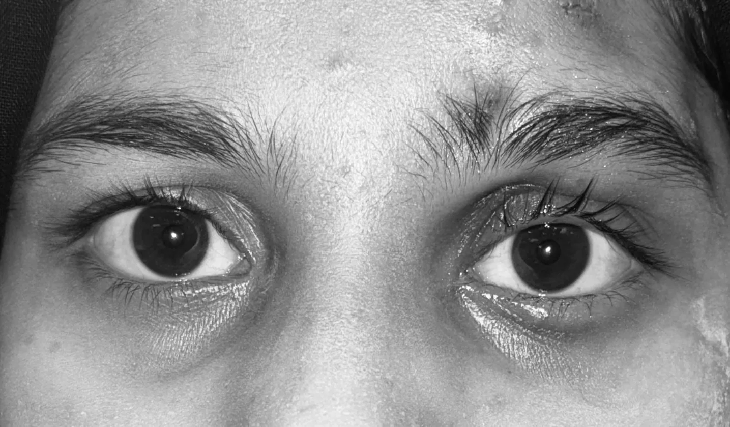 Post-operative photograph after tarsofrontal silicone sling showing improved eyelid position and symmetry