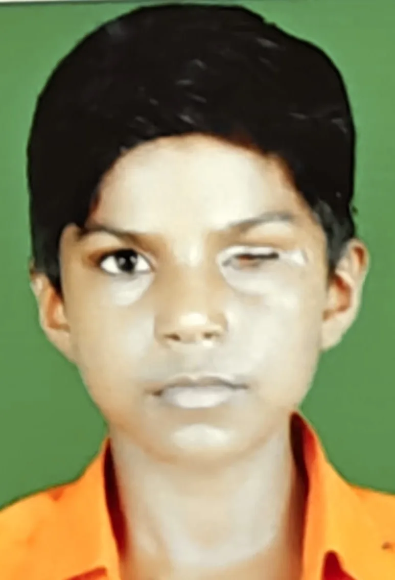 Childhood photograph after enucleation for retinoblastoma showing a contracted socket with no implant