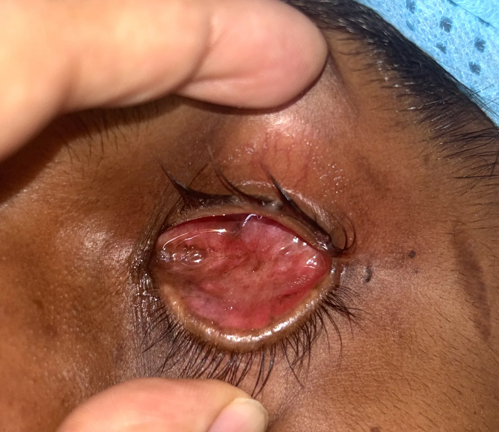 Severely contracted socket with reduced fornical depth and inadequate conjunctival lining