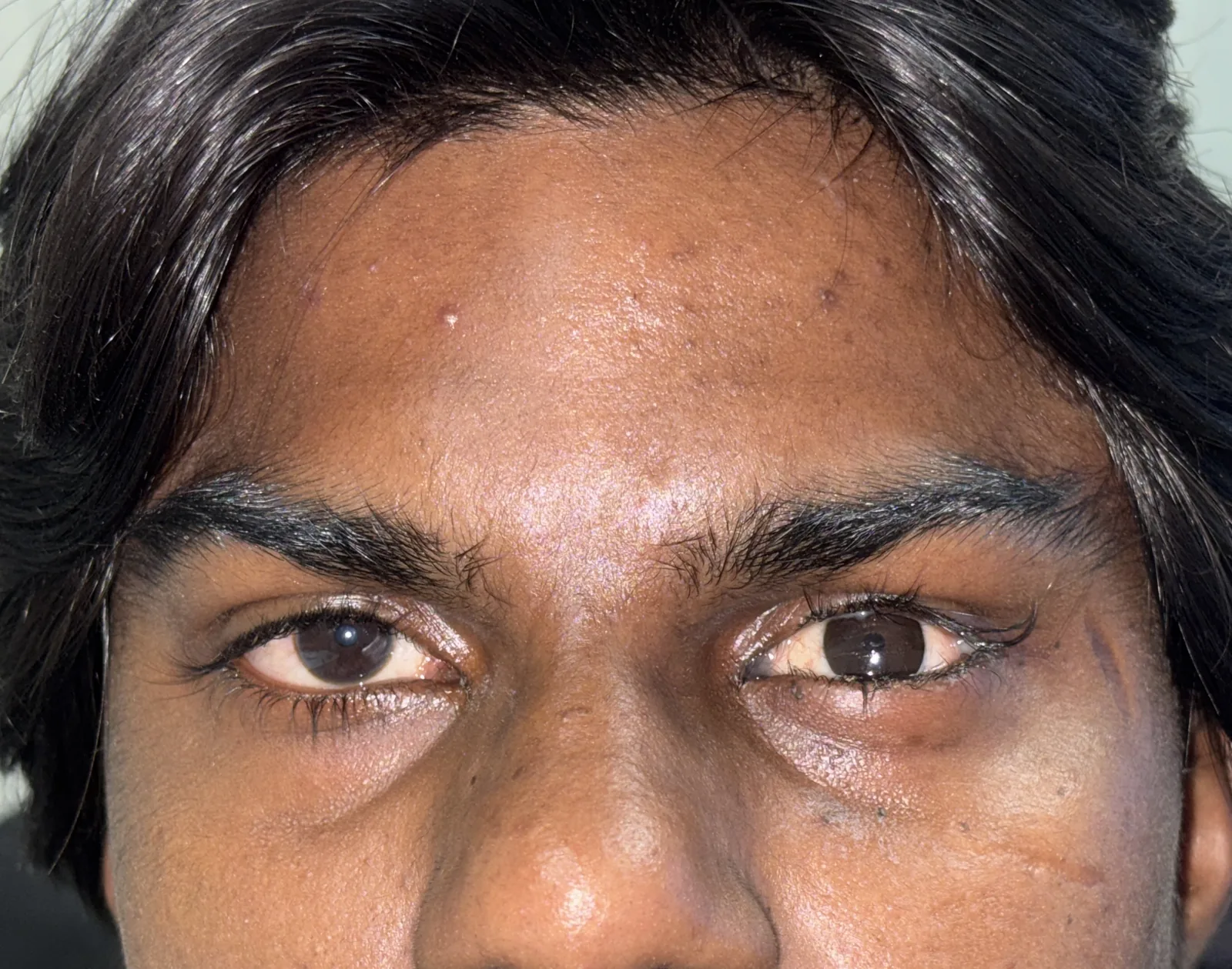 Final outcome with a well-fitting custom ocular prosthesis and restored symmetric facial appearance