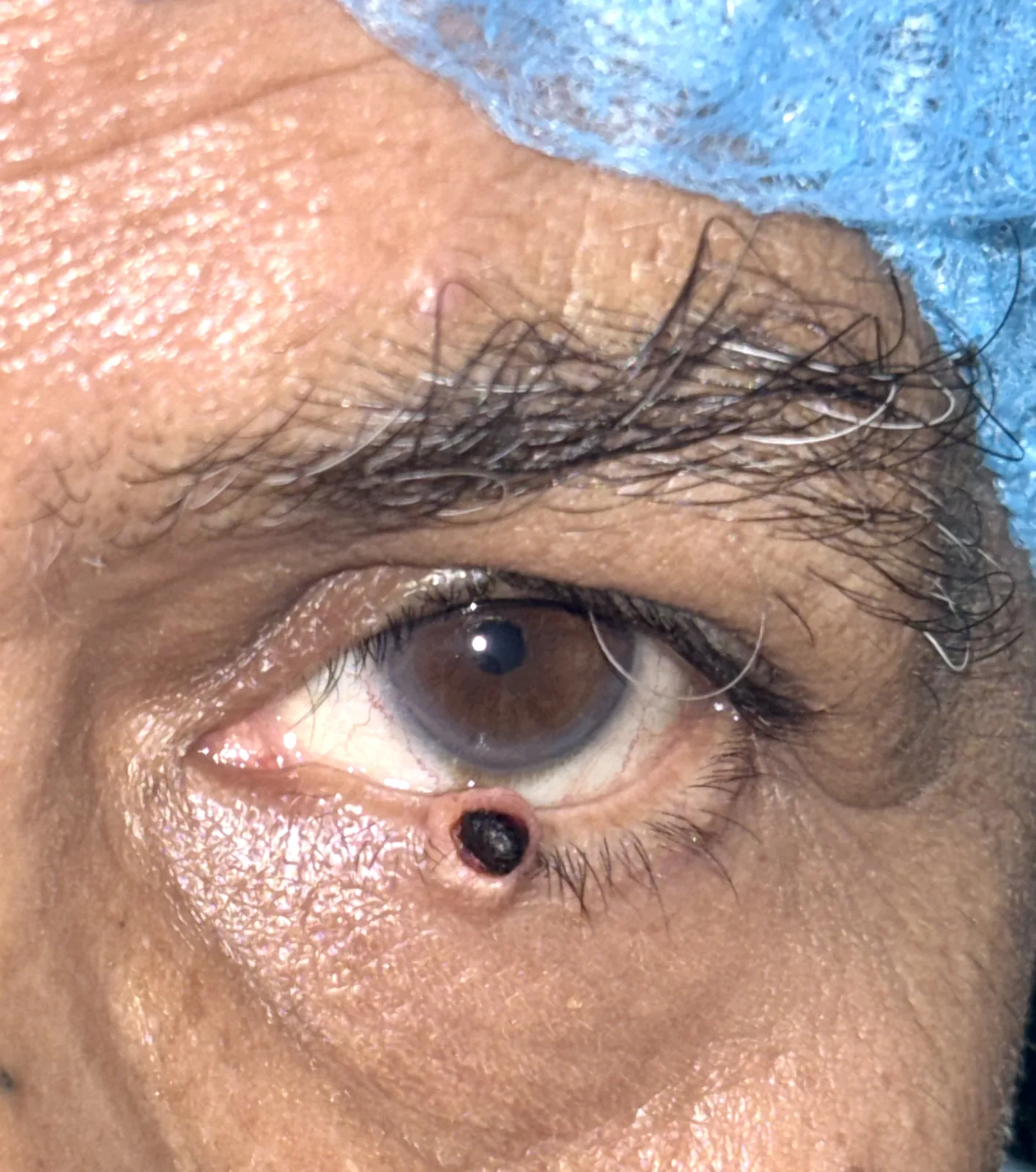 Pre-operative photograph showing sebaceous gland carcinoma of the left lower eyelid