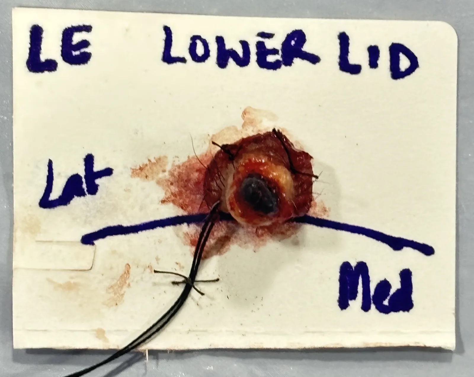 Excised specimen labelled left eye lower lid with lateral and medial orientation markers