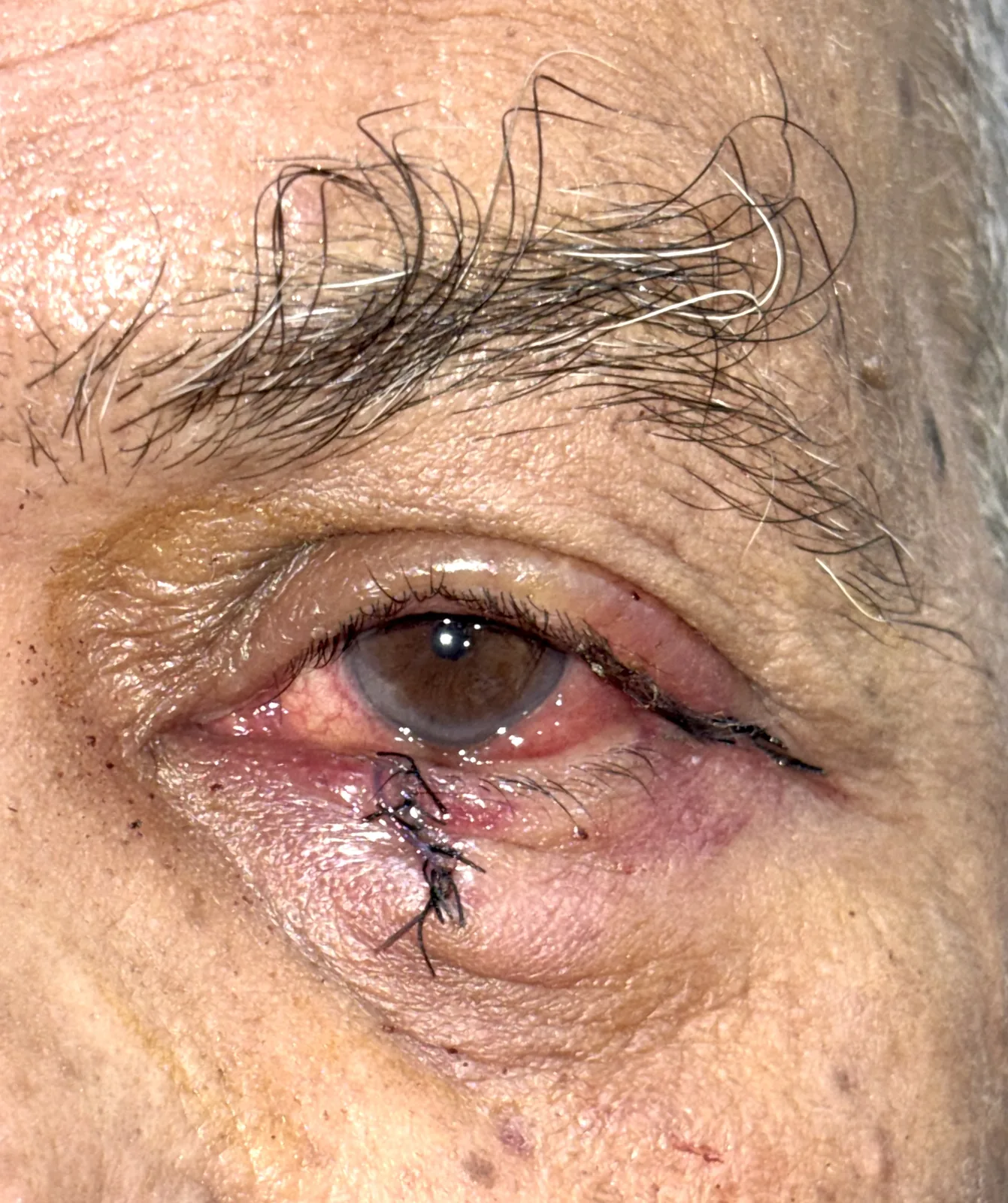 Immediate post-operative photograph after eyelid reconstruction with sutures in place