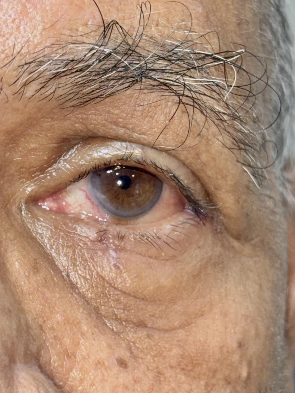 Two weeks post-operative photograph showing good healing and well maintained eyelid contour